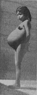 Lina Medina